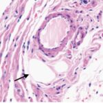 Sinus node (exposed, month 12)